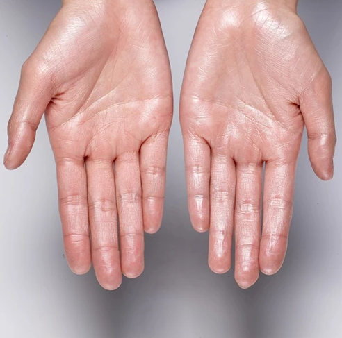 Eliminação de Suor nas Mãos