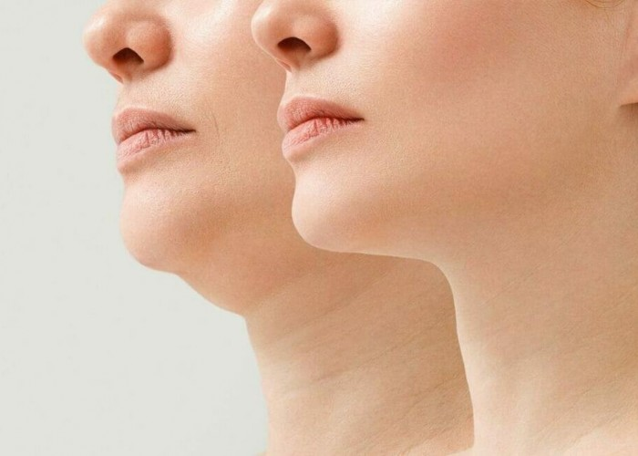 Redução de Papada (Lipo de Papada)